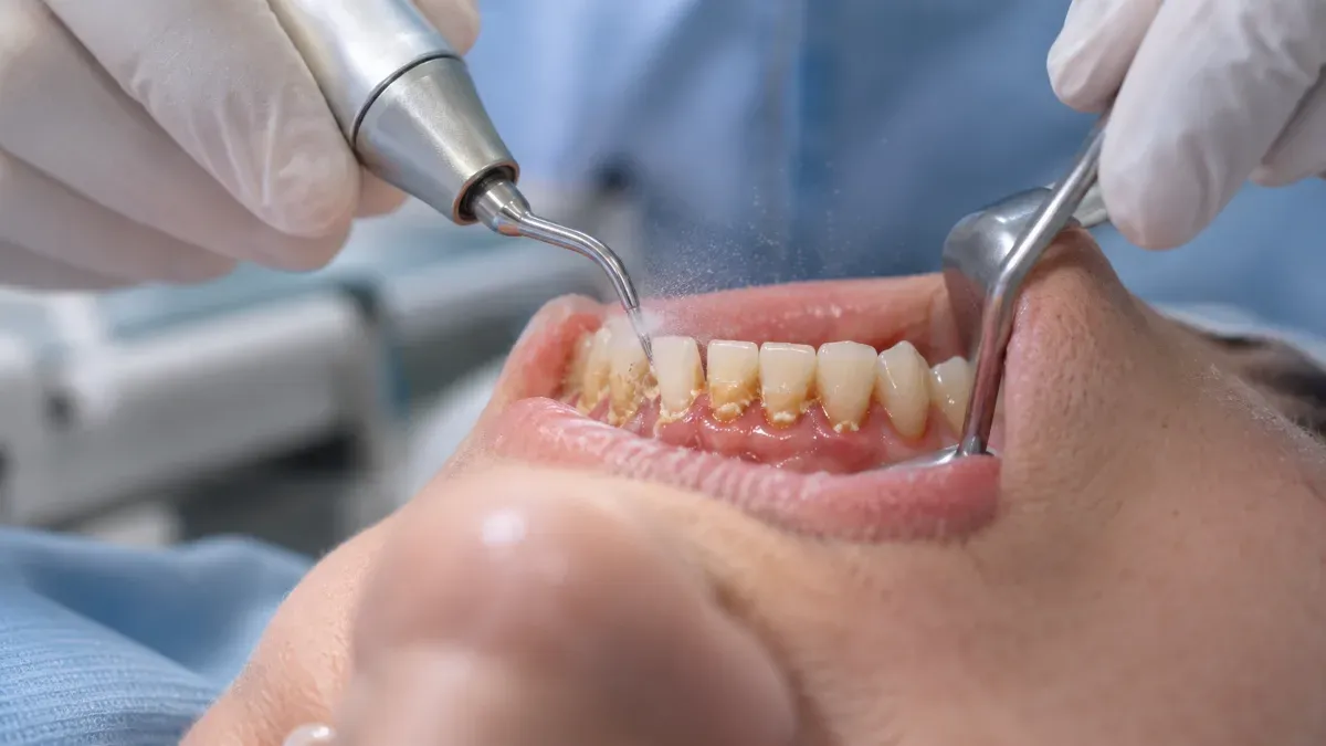 Diş hekimi koltuğunda hastanın alt ön dişlerindeki sert birikimleri ultrasonik scaler ile temizleyen hekimin yakın plan klinik sahnesi